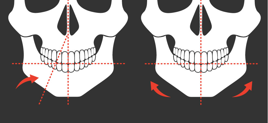 · 切开下颚的中央部位后,进行拉动或微削两侧骨的方法